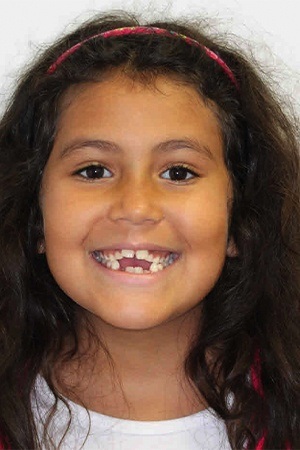 Young girl with gaps in smile before orthodontic treatment