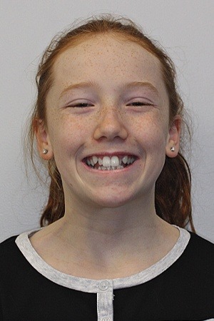 Teen girl with overlapping teeth before braces