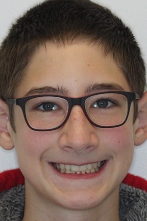 Teen boy with gorgeous smile after braces