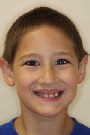 Preteen boy with misaligned smile before braces