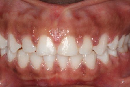 Closeup of perfectly aligned smile after orthodontics