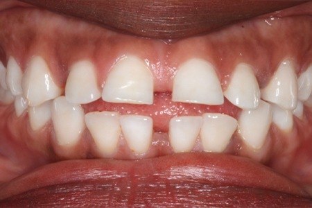 Closeup of smile with gaps between teeth before orthodontics