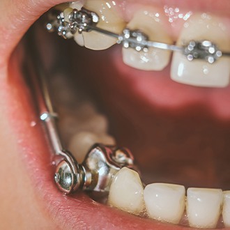 Closeup of smile with an orthodontic appliance in place