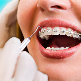 exam of a woman’s traditional braces in Webster