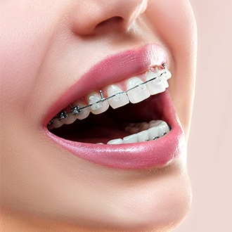 Closeup of smile with clear and ceramic braces