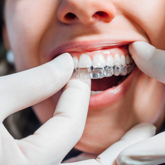 Dentist placing clear aligner on patient