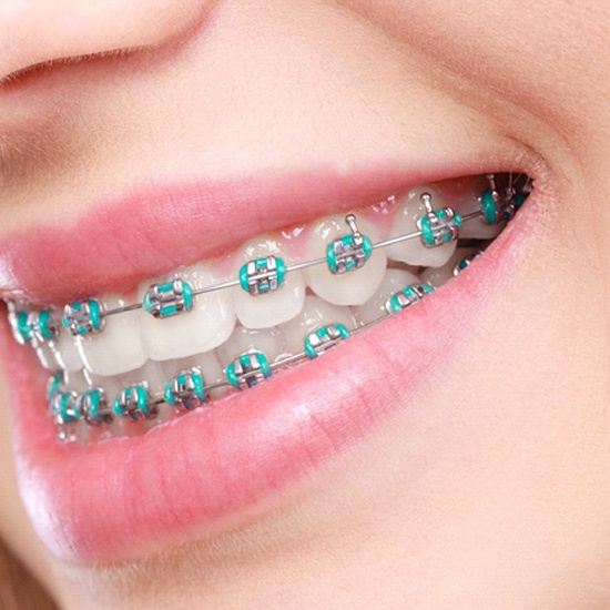 Closeup of patient with braces in Webster