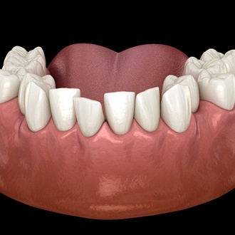 Diagram of overcrowded teeth in Webster before orthodontics