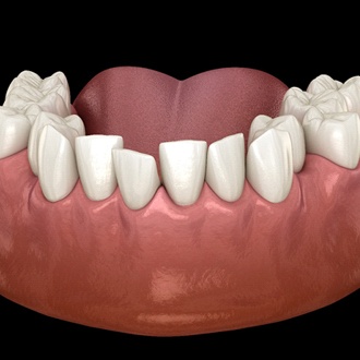 Diagram of overcrowded teeth in Webster before orthodontics