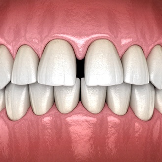 Diagram of gapped teeth in Webster before orthodontics