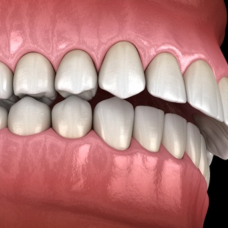 Diagram of overbite in Webster before orthodontics