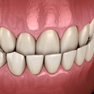 Diagram of underbite in Webster before orthodontics