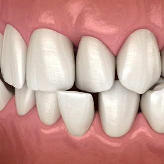 Diagram of crossbite in Webster before orthodontics