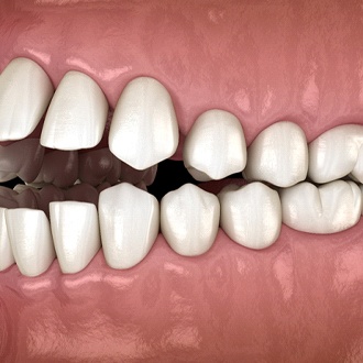 Diagram of open bite in Webster before orthodontics