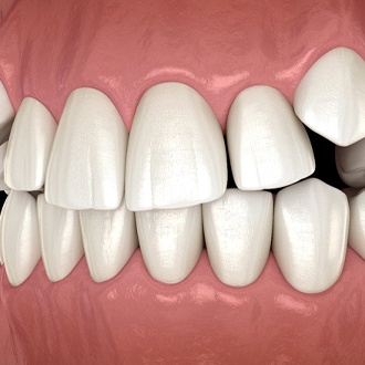 Diagram of impacted canines in Webster before orthodontics