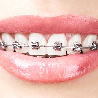 Closeup of smile with self ligating braces