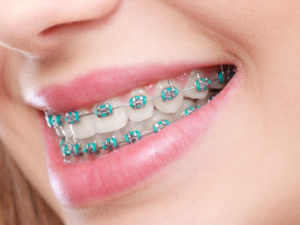 Closeup of smile with braces in Webster