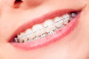 Closeup of smile with modern braces in Webster
