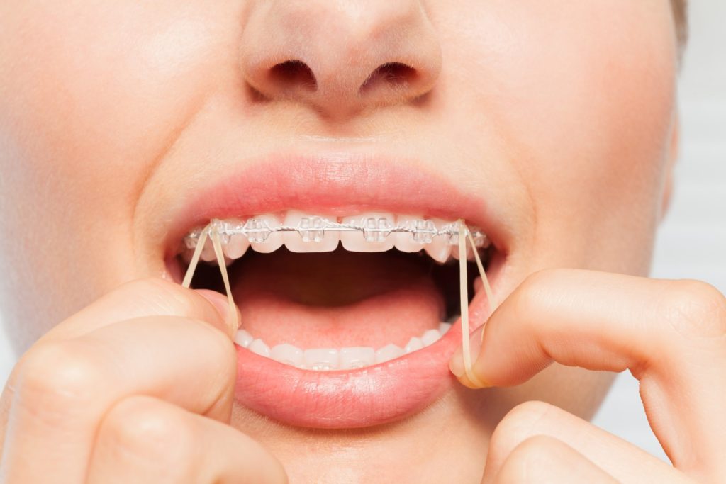 Closeup of patient putting rubber bands on brackets