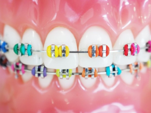 closeup of model teeth with colored rubber bands