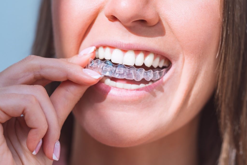 Patient placing retainer on top teeth